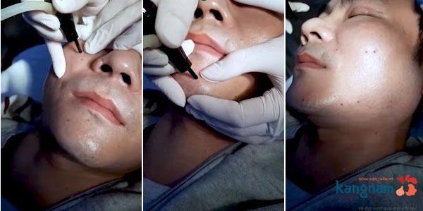 Ngay khi vừa thực hiện bắn laser, da khách hàng không bị ửng đỏ, bỏng rát Ngay khi vừa thực hiện bắn laser, da khách hàng không bị ửng đỏ, bỏng rát