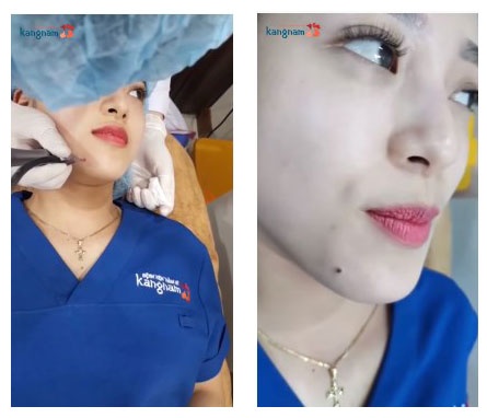 tẩy nốt ruồi có hại không