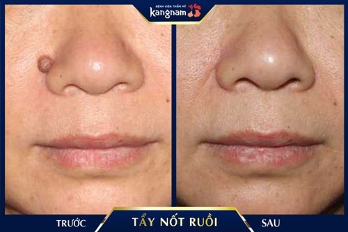 Kết quả thể hiện ngay sau khi kết thúc liệu trình điều trị tẩy nốt ruồi bằng thuốc đánh răng