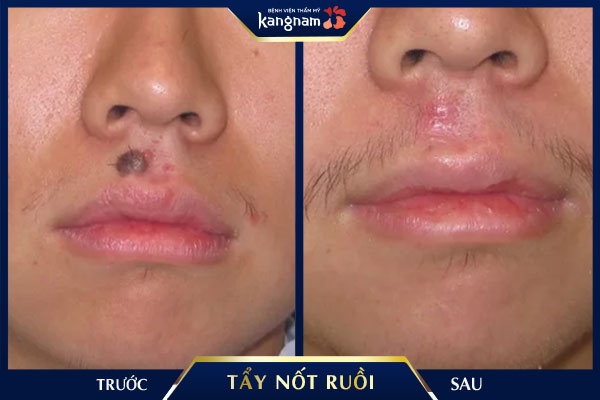 tẩy nốt ruồi mấy ngày lành