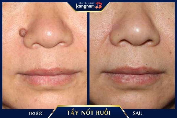 tẩy nốt ruồi hết bao nhiêu tiền tẩy nốt ruồi hết bao nhiêu tiền