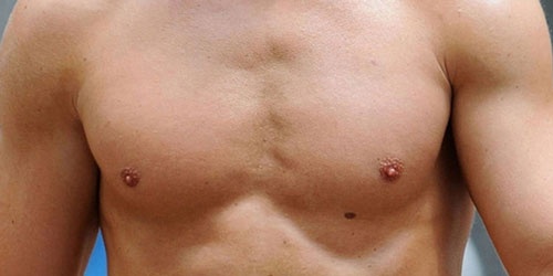 nốt ruồi ở dưới nhũ hoa nốt ruồi ở dưới nhũ hoa