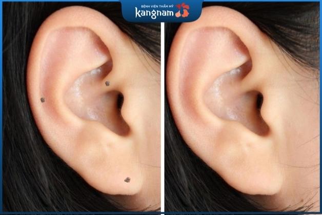 Tẩy nốt ruồi ở tai an toàn tại Kangnam