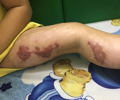 Vết sẹo để lại cả đời nếu bố mẹ cho con tẩy nốt ruồi sai cách, không đảm bảo vệ sinh trong quá trình chăm sóc