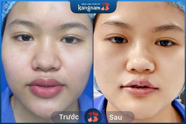 Tùy theo dáng mỗi của từng khách hàng mà bác sĩ sẽ tư vấn phương pháp chỉnh sửa phù hợp (*)