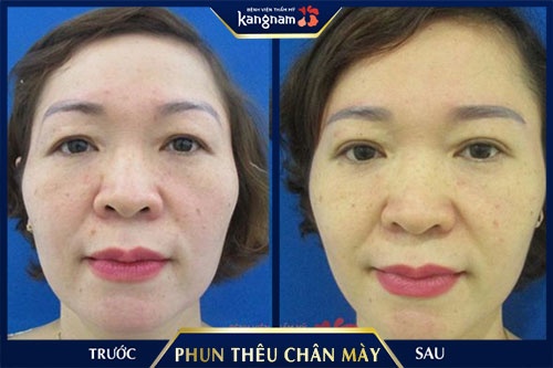 thêu lông mày đau không