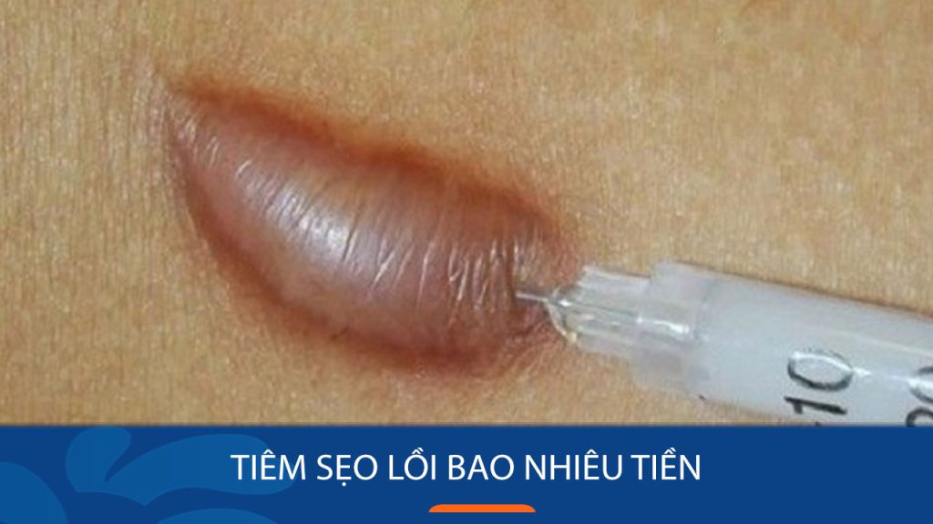 Tất tần tật về tiêm sẹo lồi: Quy trình, chi phí và lưu ý