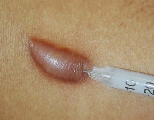 Tiêm thuốc có thể làm giảm tình trạng sẹo từ 70% - 80% Tiêm thuốc có thể làm giảm tình trạng sẹo từ 70% - 80%