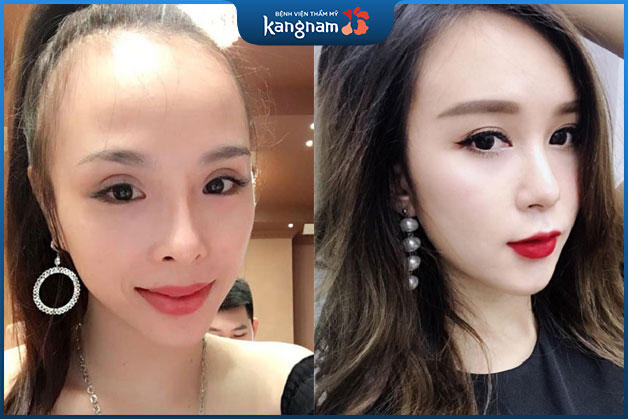 Trán dô từ xưa tới nay luôn kém duyên dáng, không được xinh đẹp