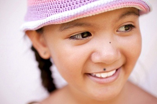 Các bậc phụ huynh không nên tự ý phá nốt ruồi cho con bằng các phương pháp dân gian, tự nhiên tại nhà