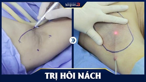 triệt lông nách có hết hôi nách