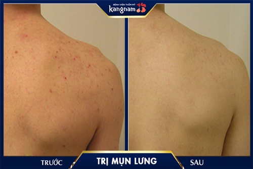 Hình ảnh trước - sau trị mụn lưng bằng công nghệ hiện đại cho thấy hiệu quả rõ rệt= Hình ảnh trước - sau trị mụn lưng bằng công nghệ hiện đại cho thấy hiệu quả rõ rệt