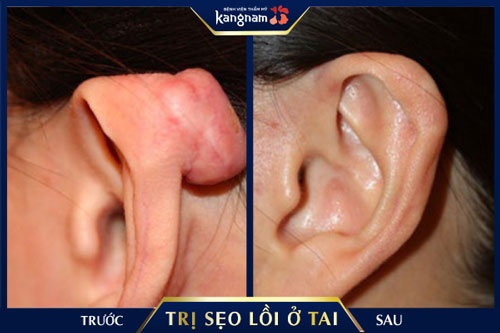 Khắc phục sẹo lồi ở vành tai sẹo lồi ở vành tai