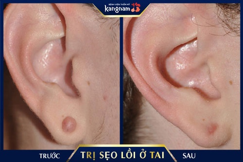 Kết quả trị sẹo lồi ở sụn tai sẹo lồi ở sụn tai
