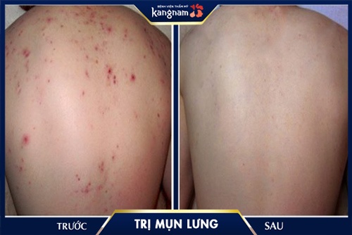 chữa mụn kangnam Lưng trở nên mịn màng hơn sau khi mụn đã được loại bỏ