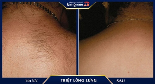 Vùng lông lưng dài rậm đã được tẩy sạch hoàn toàn chỉ sau 1 liệu trình điều trị tại Bệnh viện thẩm mỹ Kangnam triệt lông lưng vĩnh viễn