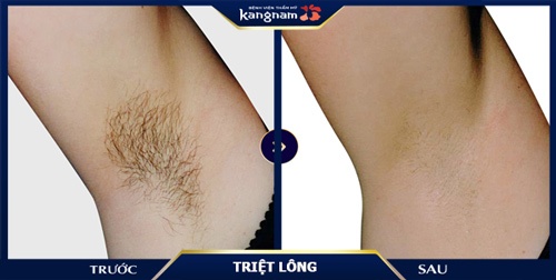 triệt lông nách có ảnh hưởng gì không 