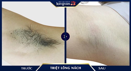 triệt lông nách có làm hôi nách 