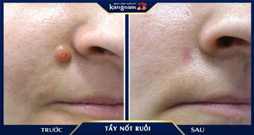 Mụn ruồi lớn, lồi nhiều trên bề mặt da đã được xử lý triệt để sau 1 liệu trình sử dụng Laser CO2 Fractional