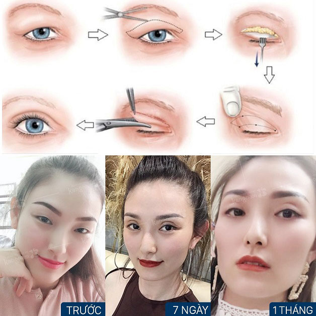 Cắt mí không để lại sẹo