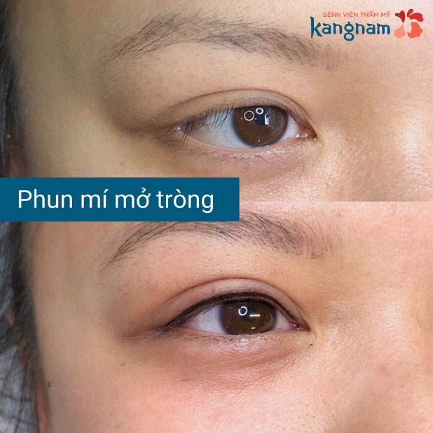 Đôi mắt to tròn long lanh và có hồn hơn sau phun xăm mí mắt