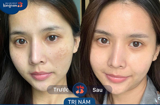 Nám đã được khắc phục hoàn toàn đến 99%, ngăn ngừa khả năng tái phát trở lại