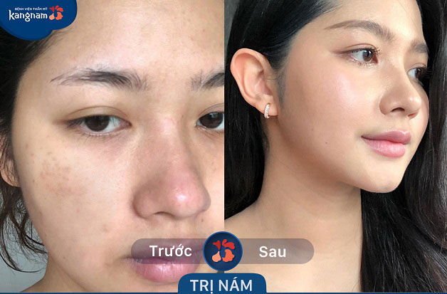 rKhách hàng rất hài lòng với kết quả điều trị nám da của mình