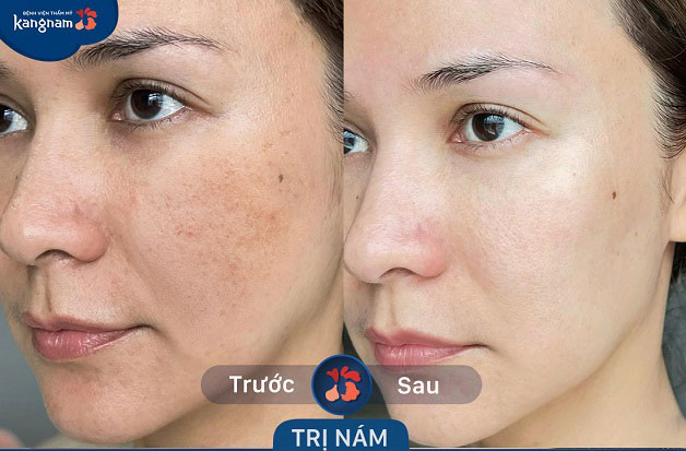 Làn da hiện tại của chị đã sáng mịn, đều màu sau khi khách hàng trị nám tại Kangnam 