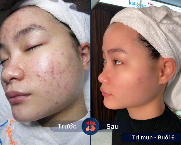 Khách hàng sau khi điều trị mụn tại Kangnam