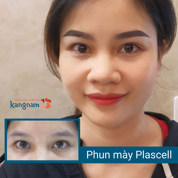 Phun chân mày hồi phục cấp tốc, không đau không sẹo xấu