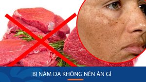 Bị nám da không nên ăn gì và những nhóm thực phẩm tốt