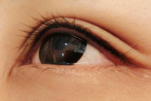 Phun mí mở tròng có sưng không do nhiều yếu tố khác nhau gây nên