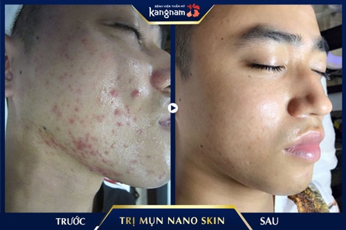 trị mụn nano skin sữa rửa mặt cho tuổi dậy thì