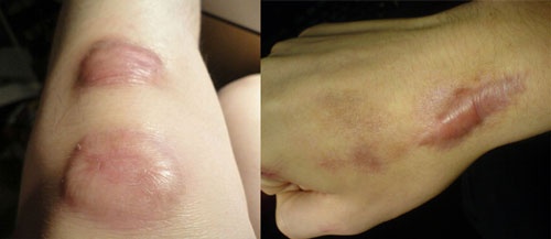 cách trị sẹo té xe trên mặt Các dạng sẹo ngã xe