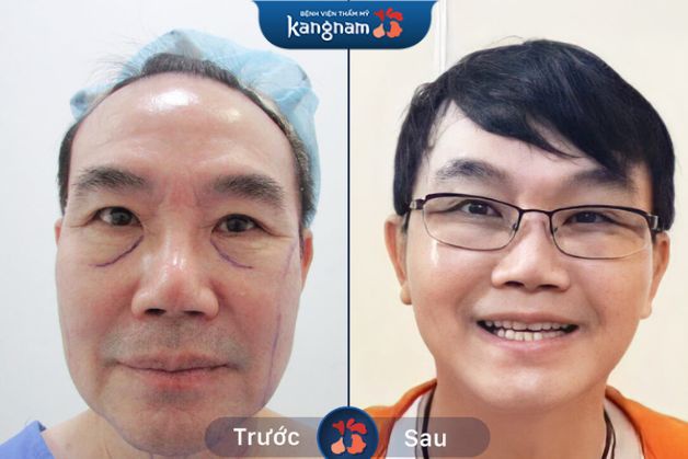 Chị Thu (Bình Định) chia sẻ rất vui khi thấy gương mặt mình trẻ ra nhiều tuổi chỉ sau 1 tiếng điều trị. Toàn bộ vùng da chùng nhão, nếp nhăn sâu gần như biến mất giúp chị như đang quay về tuổi 30. Căng da trẻ hóa