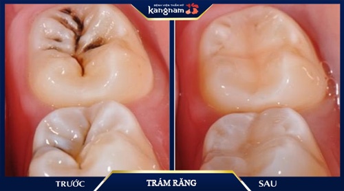 chi phí trám răng