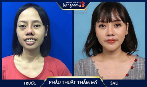 có nên phẫu thuật thẩm mỹ hay không