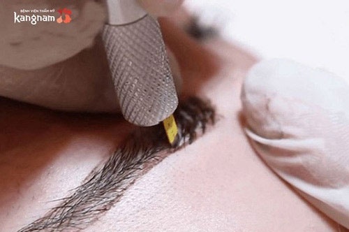 điêu khắc lông mày có để lại sẹo không