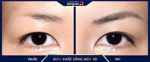 điêu khắc chân mày có để lại sẹo không