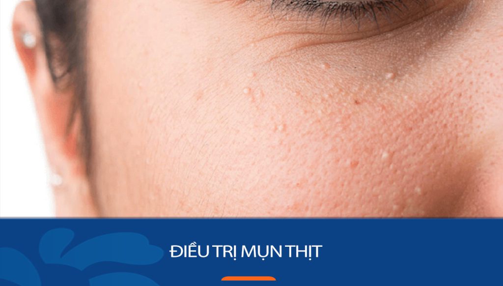 14 Cách Trị Mụn Thịt Tại Nhà Dứt Điểm, Hiệu Quả NHANH NHẤT