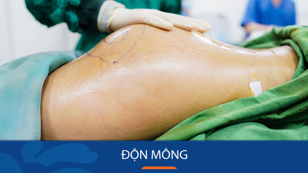 Độn mông – Bí quyết hô biến vòng 3 nhỏ, lép thành căng tròn