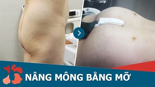 Vòng 3 căng tròn sau bơm mỡ tự thân, khắc phục hoàn toàn tình trạng mông hóp độn mông tự thân
