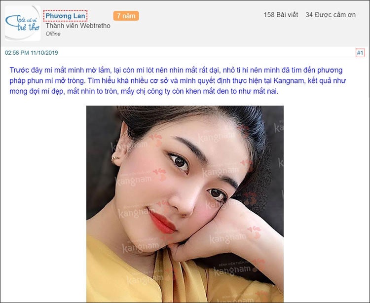 Review thực tế của Khách hàng Kangnam sau khi phun mí mở tròng mắt mèo kết quả xăm mí mắt mèo