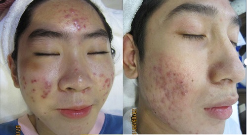 Trường hợp mụn bọc sưng, mụn viêm không thể điều trị bằng cách lăn kim tế bào gốc