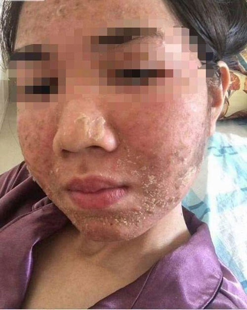Trường hợp da mặt sưng, kích ứng sau khi lăn kim ở spa (nguồn: Báo mới)