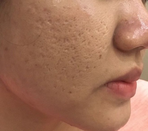 Tình trạng lỗ chân lông to, sẹo rỗ sau mụn có thể dùng lăn kim để khắc phục