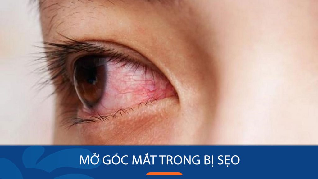 Mở góc mắt trong bị sẹo không? Trường hợp dễ gặp & cách hạn chế sẹo