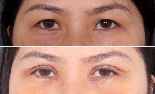 mở rộng góc mắt bị sẹo mở rộng góc mắt bị sẹo