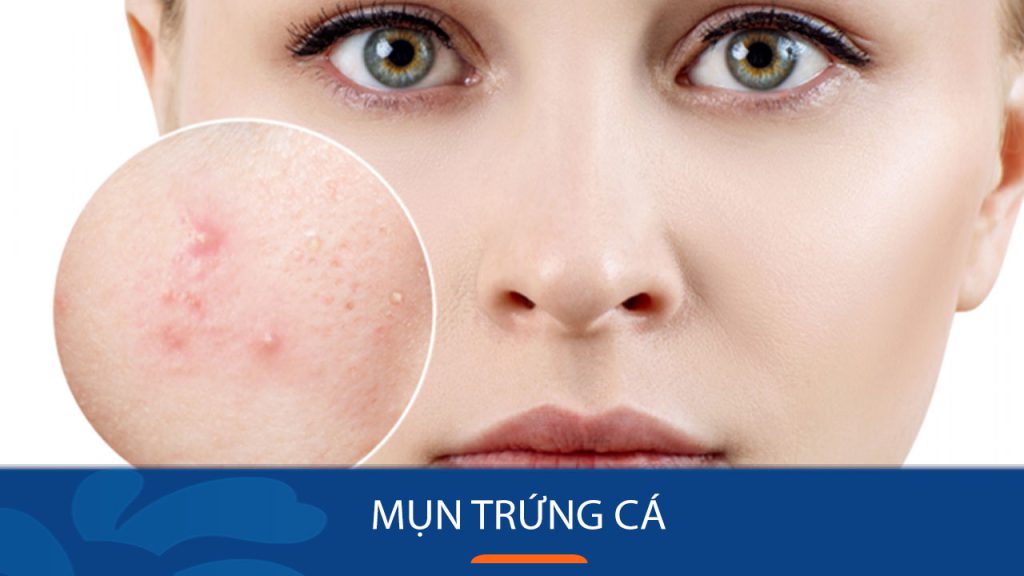 Nguyên nhân gây mụn trứng cá mà 90% người không biết