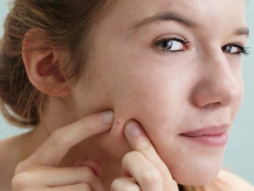 Nặn mụn khiến vi khuẩn lây nhiễm và làm cho tình trạng mụn nặng hơn mụn dậy thì